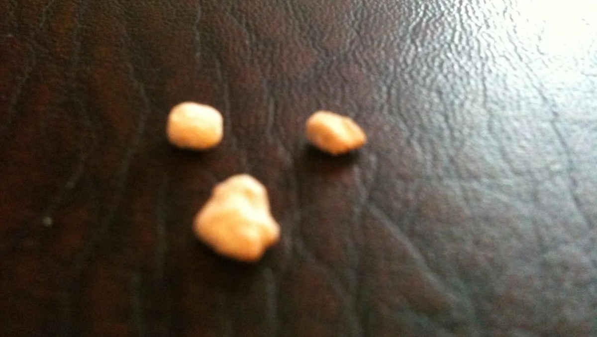 Three kidney stones